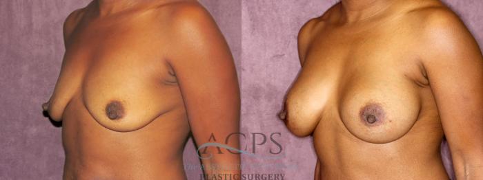 Before & After Breast Augmentation Case 822 Oblique Left View: View in Houston, TX