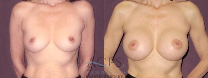 Before & After Breast Augmentation Case 823 Front View: View in Houston, TX