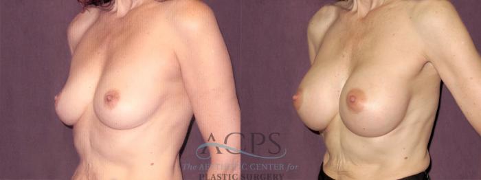 Before & After Breast Augmentation Case 823 Oblique Left View: View in Houston, TX