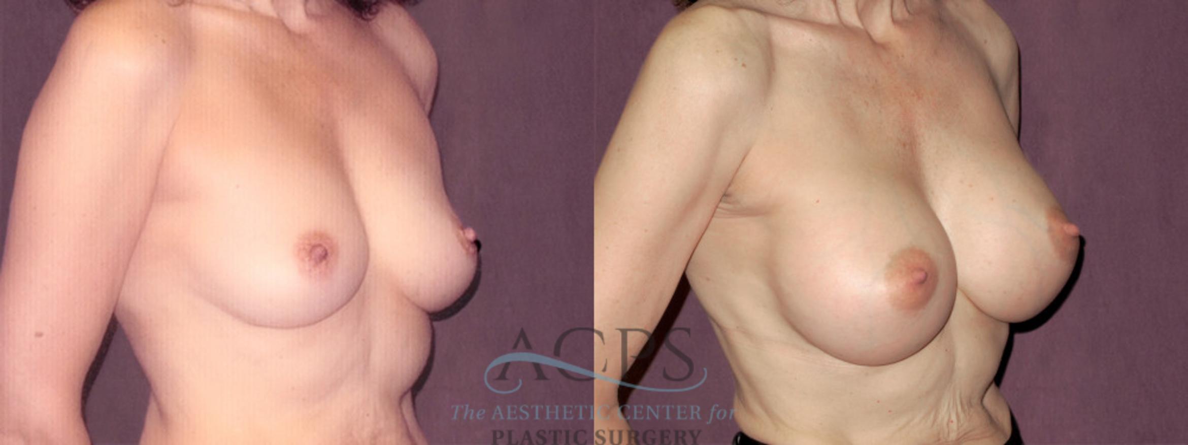Before & After Breast Augmentation Case 823 Oblique Right View: View in Houston, TX