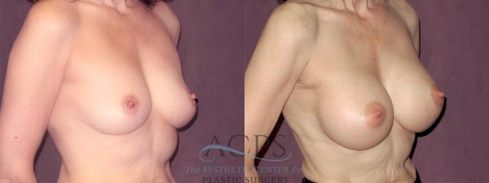 Before & After Breast Augmentation Case 823 Oblique Right View: View in Houston, TX
