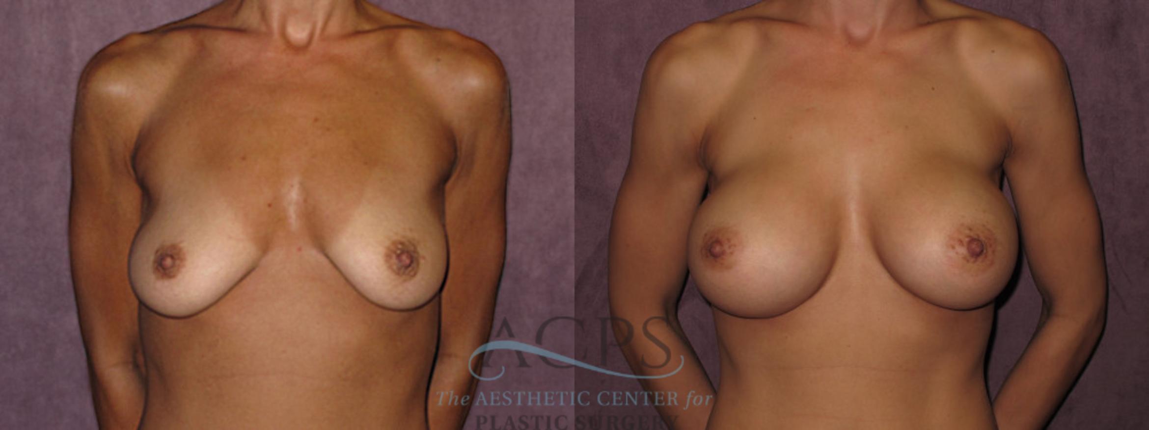 Before & After Breast Augmentation Case 824 Front View: View in Houston, TX