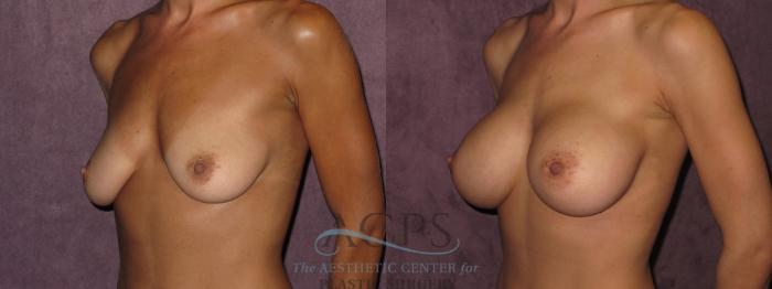 Before & After Breast Augmentation Case 824 Oblique Left View: View in Houston, TX
