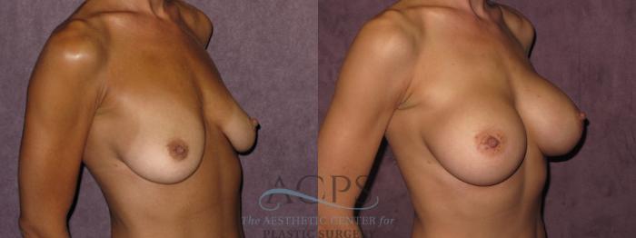 Before & After Breast Augmentation Case 824 Oblique Right View: View in Houston, TX