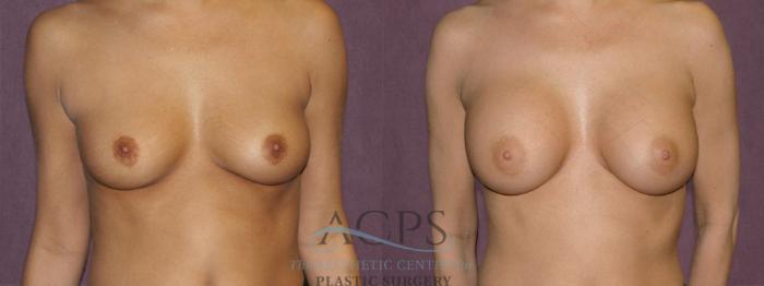 Before & After Breast Augmentation Case 825 Front View: View in Houston, TX