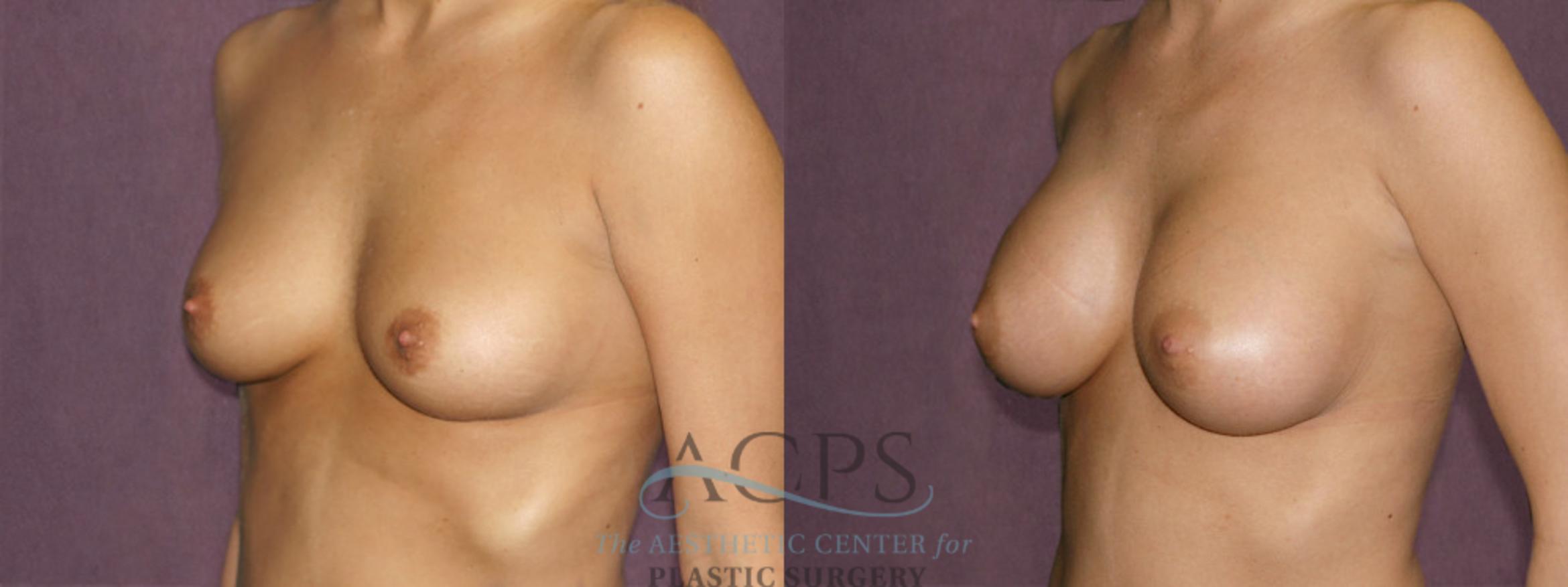 Before & After Breast Augmentation Case 825 Oblique Left View: View in Houston, TX