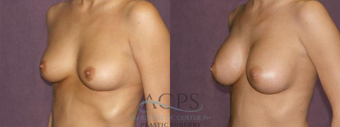 Before & After Breast Augmentation Case 825 Oblique Left View: View in Houston, TX