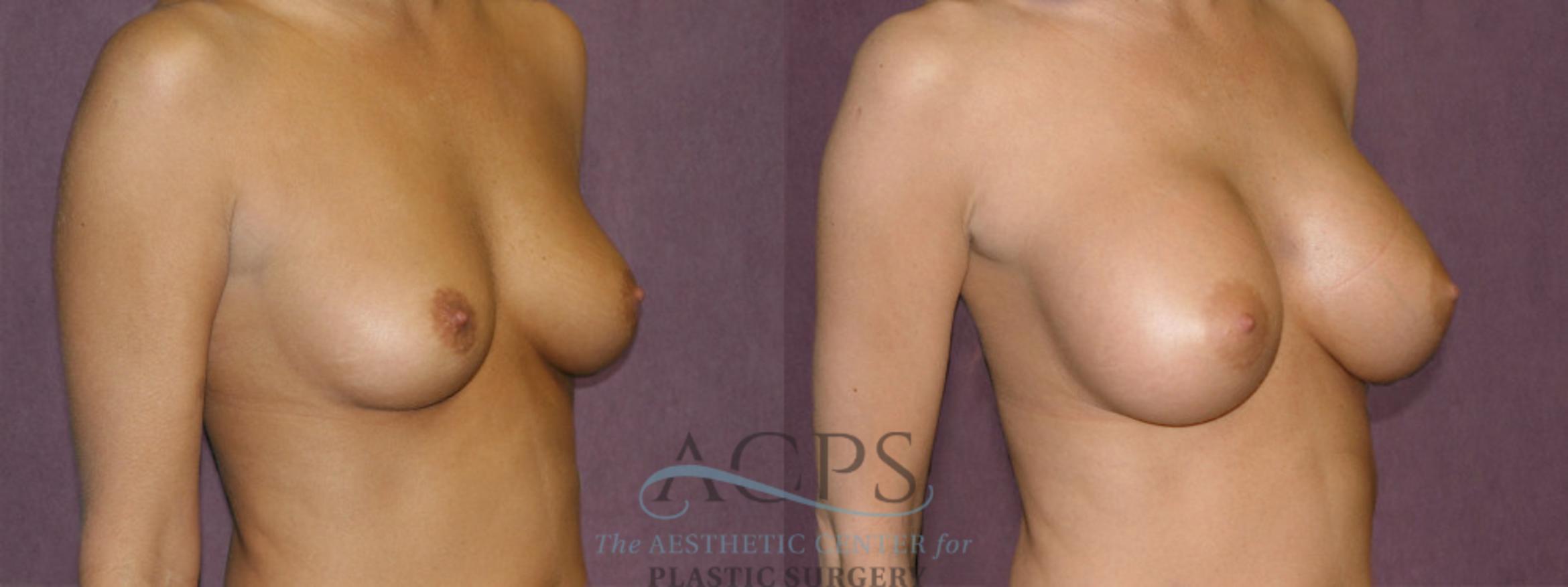 Before & After Breast Augmentation Case 825 Oblique Right View: View in Houston, TX