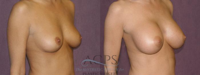 Before & After Breast Augmentation Case 825 Oblique Right View: View in Houston, TX