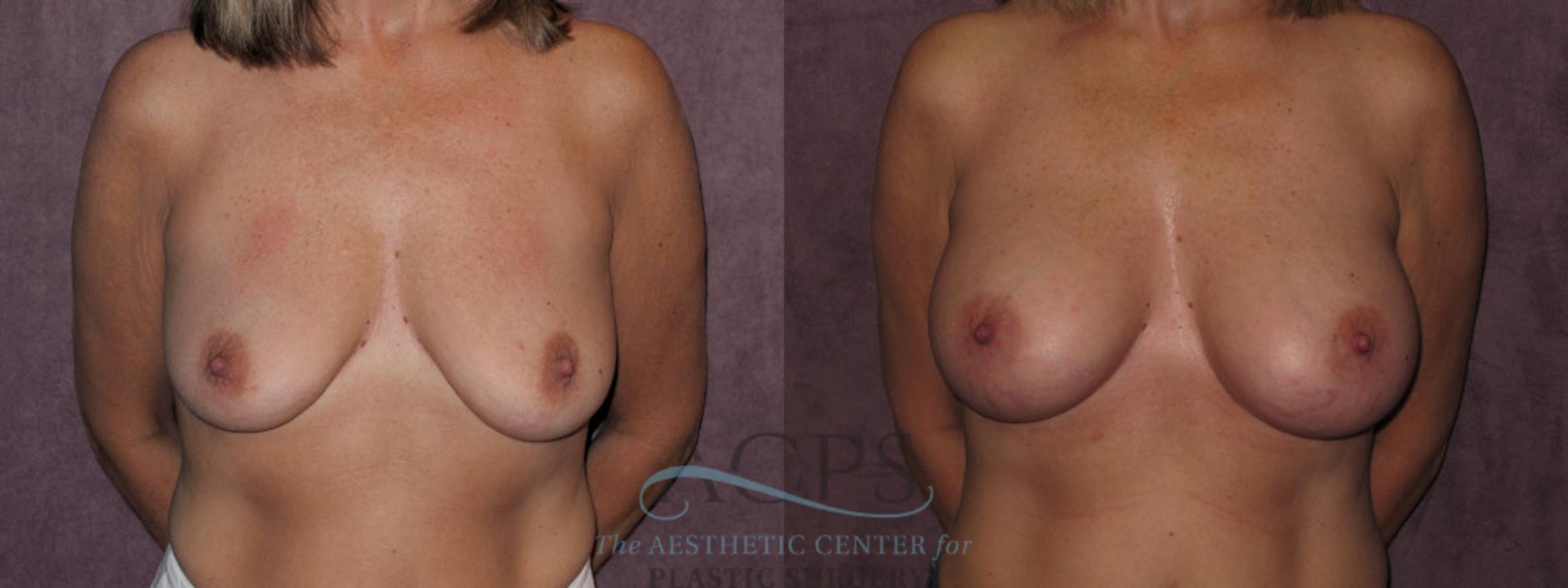 Before & After Breast Augmentation Case 826 Front View: View in Houston, TX