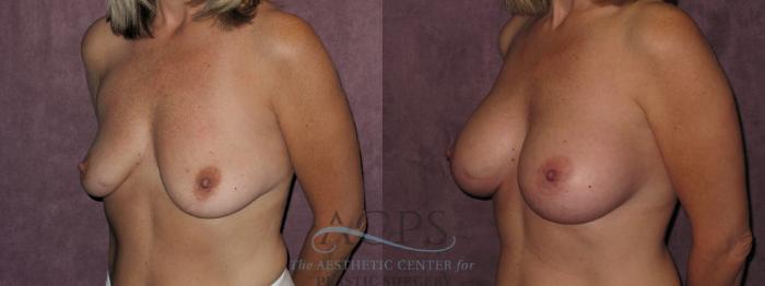 Before & After Breast Augmentation Case 826 Oblique Left View: View in Houston, TX