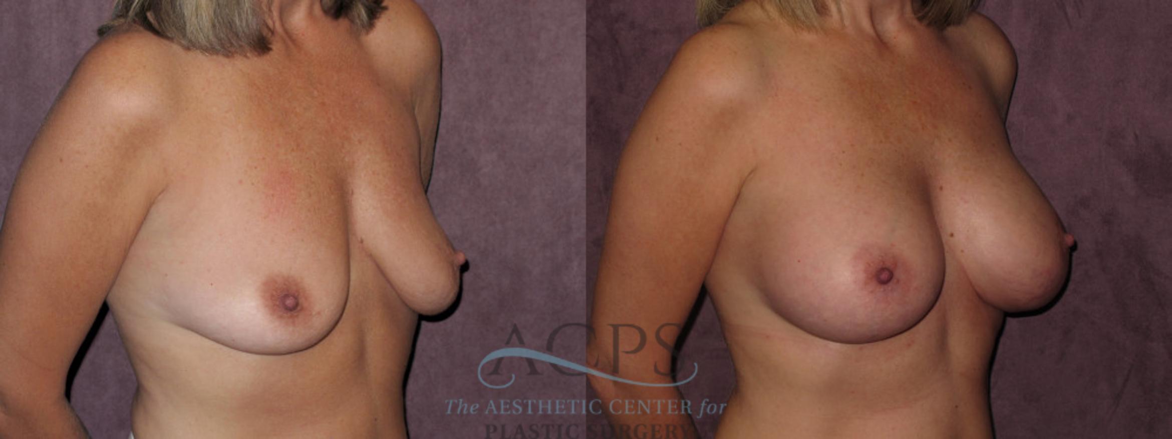 Before & After Breast Augmentation Case 826 Oblique Right View: View in Houston, TX