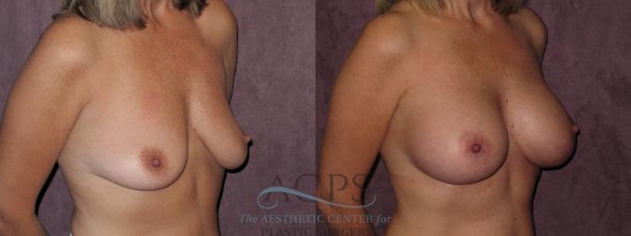 Before & After Breast Augmentation Case 826 Oblique Right View: View in Houston, TX