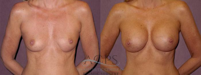 Before & After Breast Augmentation Case 827 Front View: View in Houston, TX