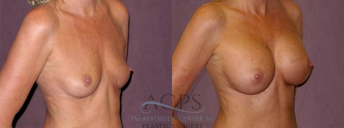 Before & After Breast Augmentation Case 827 Oblique Right View: View in Houston, TX