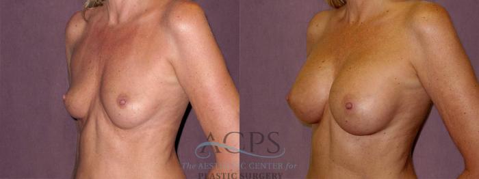 Before & After Breast Augmentation Case 827 Side Left View: View in Houston, TX