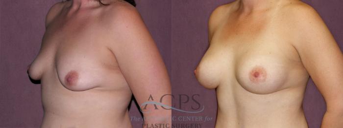 Before & After Breast Augmentation Case 828 Oblique Left View: View in Houston, TX
