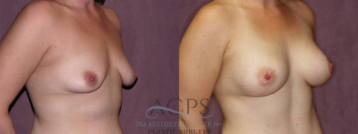 Before & After Breast Augmentation Case 828 Oblique Right View: View in Houston, TX