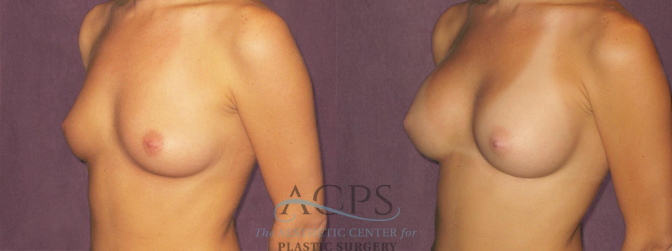 Before & After Breast Augmentation Case 829 Oblique Left View: View in Houston, TX
