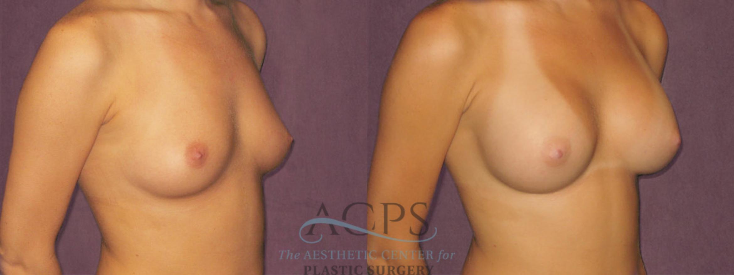 Before & After Breast Augmentation Case 829 Oblique Right View: View in Houston, TX