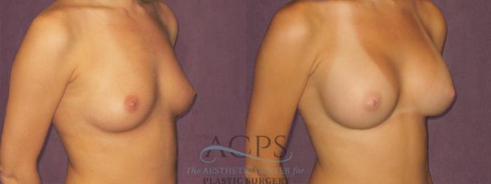 Before & After Breast Augmentation Case 829 Oblique Right View: View in Houston, TX