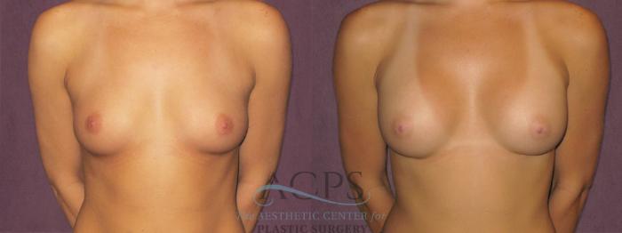 Before & After Breast Augmentation Case 829 View: View in Houston, TX