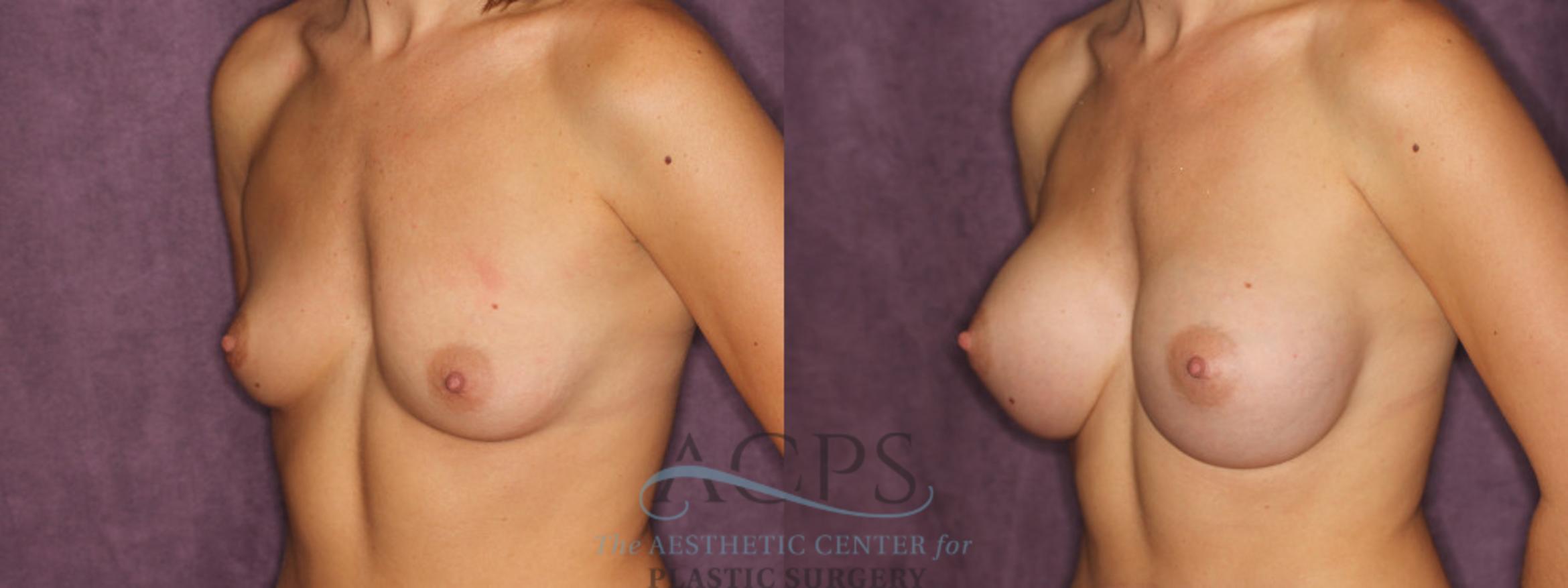 Before & After Breast Augmentation Case 830 Oblique Left View: View in Houston, TX