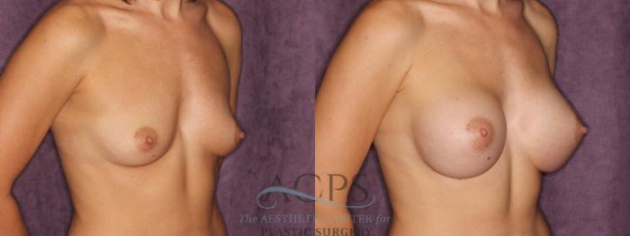 Before & After Breast Augmentation Case 830 Oblique Right View: View in Houston, TX