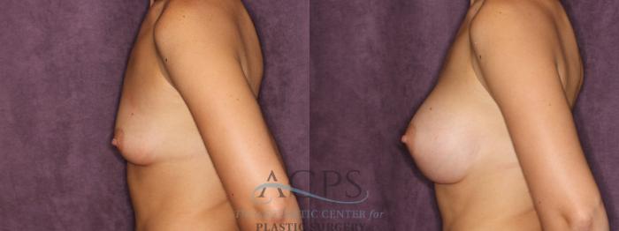 Before & After Breast Augmentation Case 830 Side Left View: View in Houston, TX