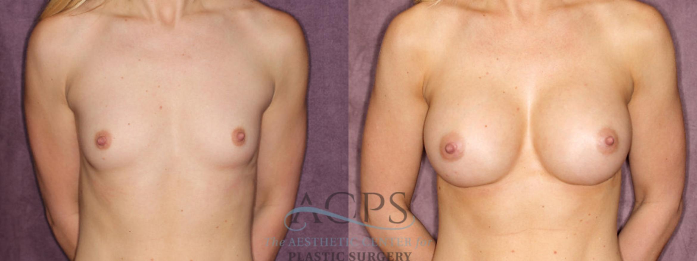 Before & After Breast Augmentation Case 831 Front View: View in Houston, TX
