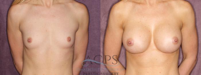 Before & After Breast Augmentation Case 831 Front View: View in Houston, TX