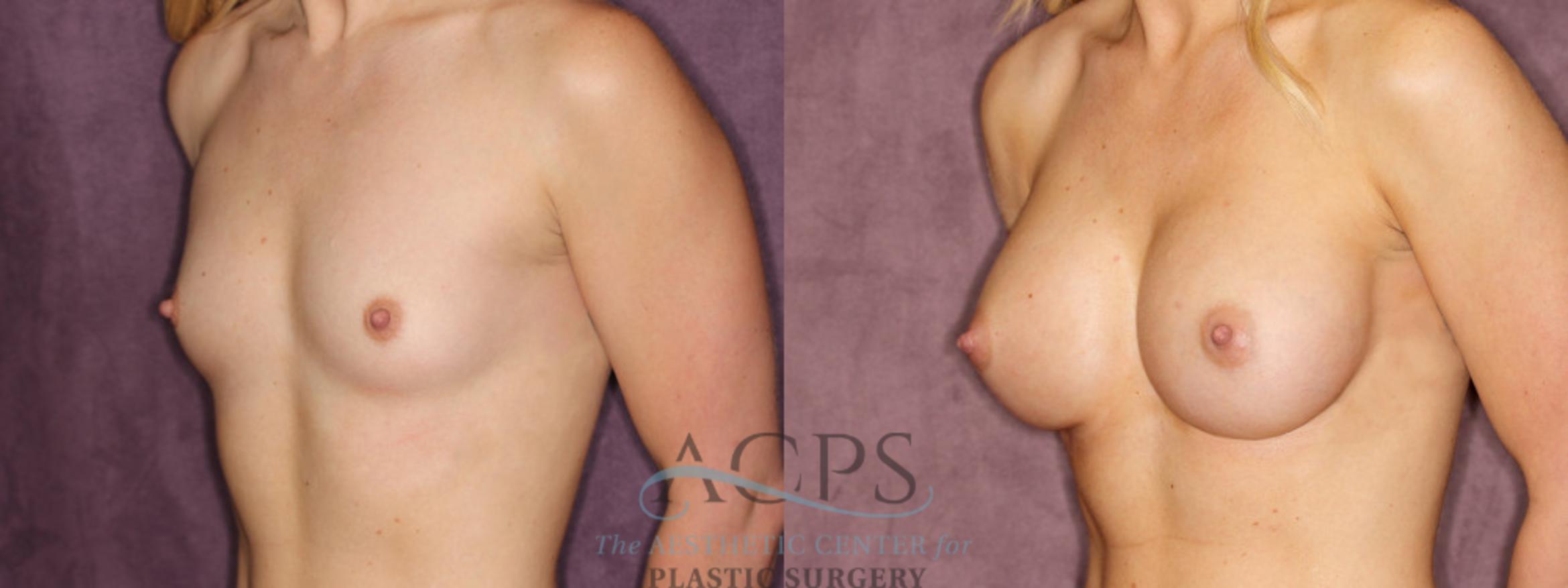 Before & After Breast Augmentation Case 831 Oblique Left View: View in Houston, TX