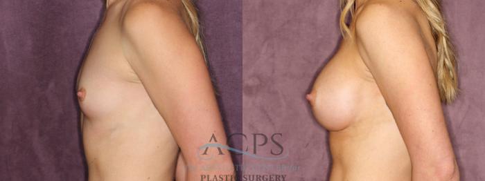 Before & After Breast Augmentation Case 831 Side Left View: View in Houston, TX