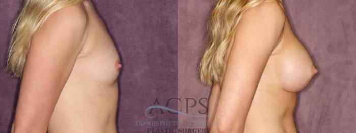 Before & After Breast Augmentation Case 831 Side Right View: View in Houston, TX