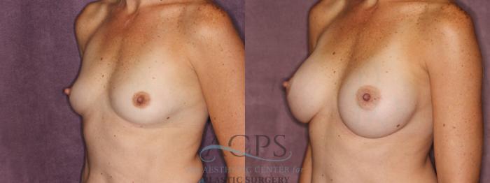 Before & After Breast Augmentation Case 832 Oblique Left View: View in Houston, TX