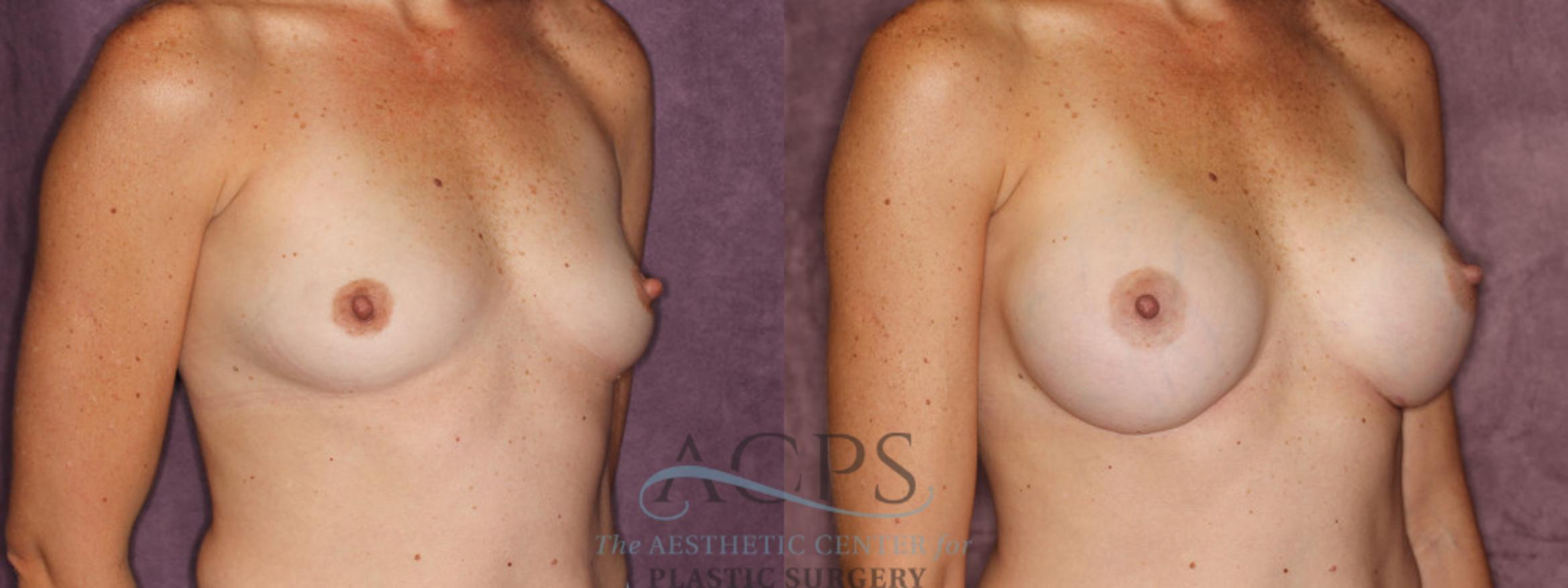 Before & After Breast Augmentation Case 832 Oblique Right View: View in Houston, TX
