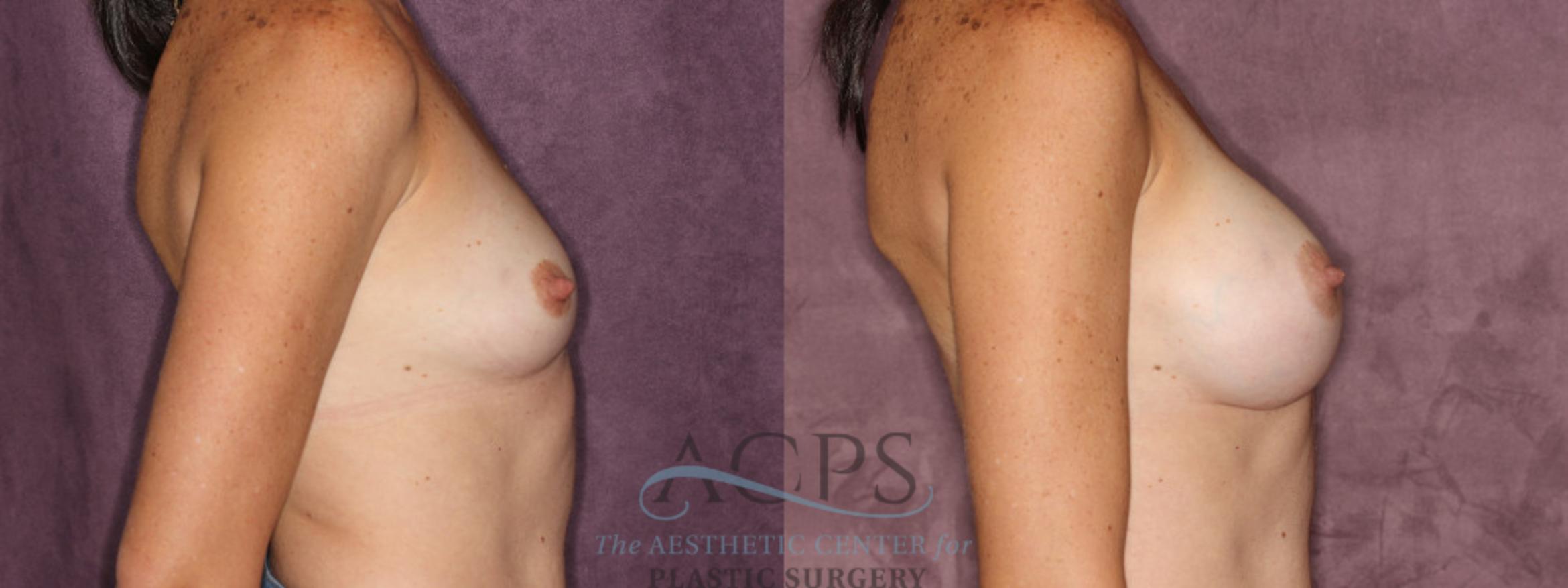 Before & After Breast Augmentation Case 832 Side Right View: View in Houston, TX
