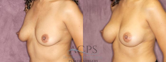 Before & After Breast Augmentation Case 833 Oblique Left View: View in Houston, TX