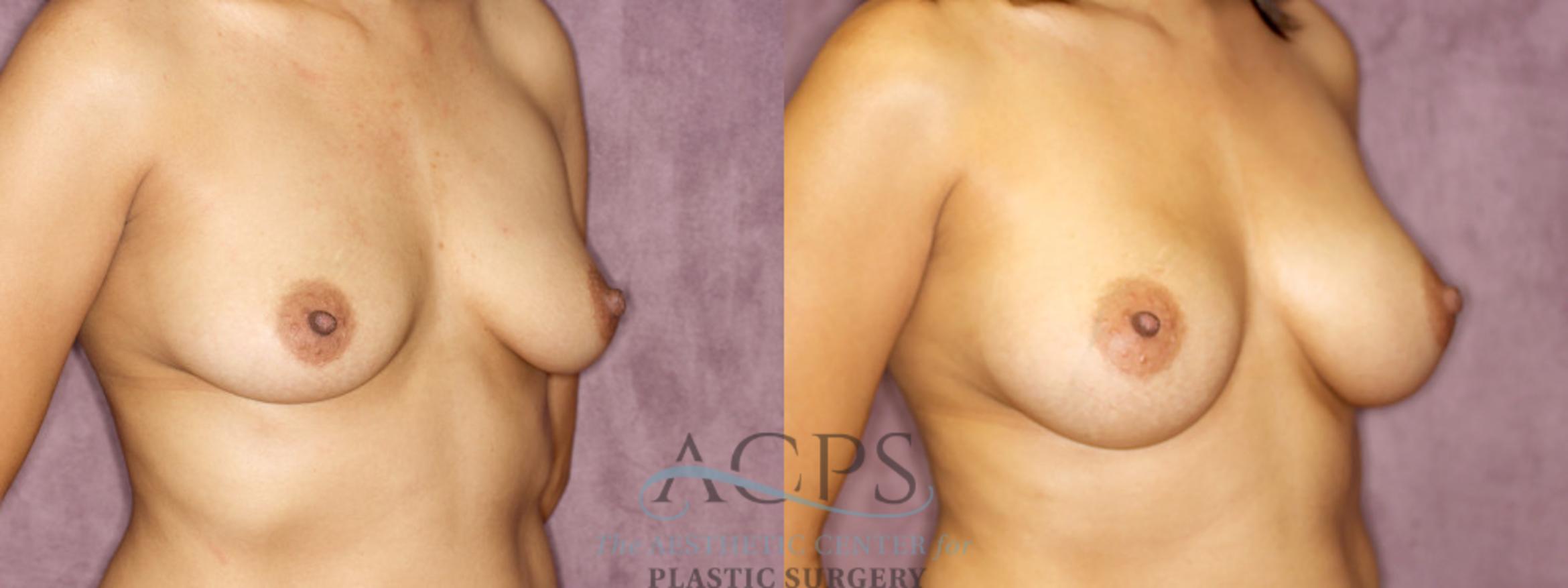 Before & After Breast Augmentation Case 833 Oblique Right View: View in Houston, TX