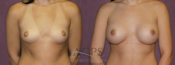 Before & After Breast Augmentation Case 834 Front View: View in Houston, TX