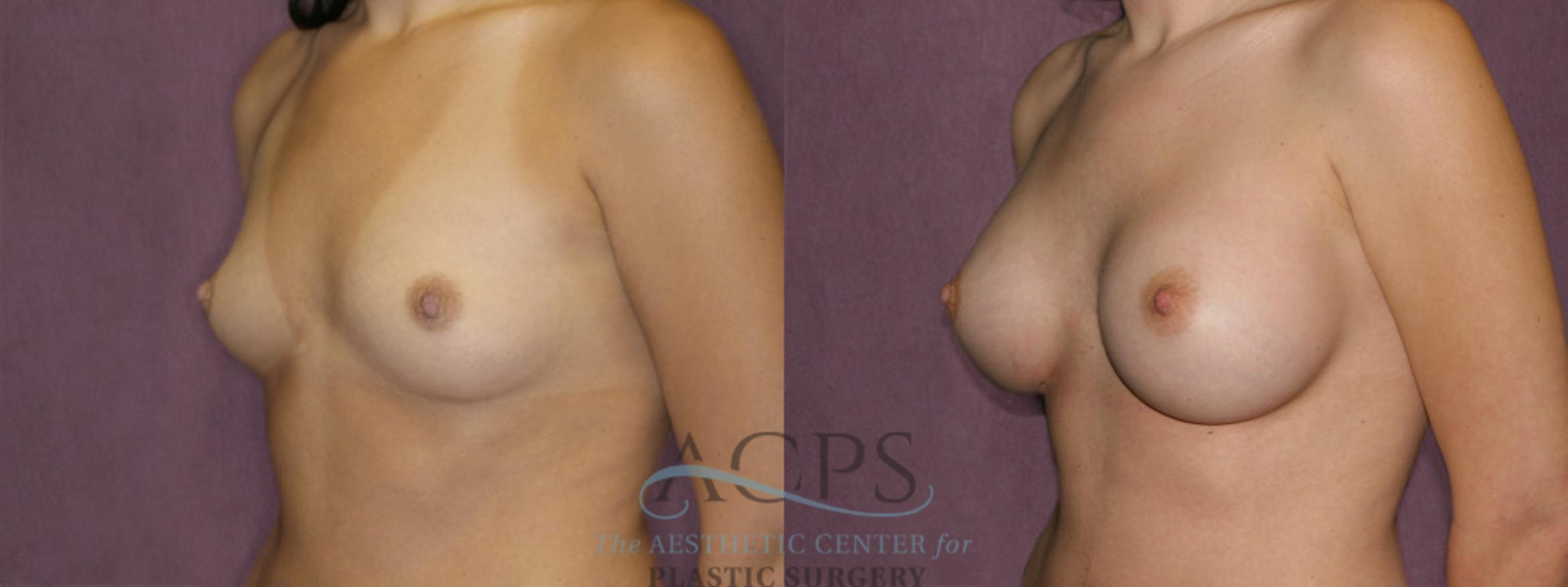 Before & After Breast Augmentation Case 834 Oblique Left View: View in Houston, TX
