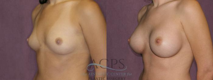 Before & After Breast Augmentation Case 834 Oblique Left View: View in Houston, TX
