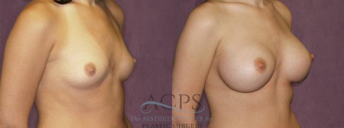 Before & After Breast Augmentation Case 834 Oblique Right View: View in Houston, TX