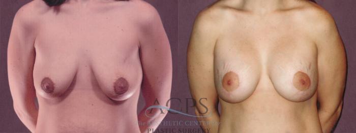 Before & After Breast Augmentation Case 835 Front View: View in Houston, TX