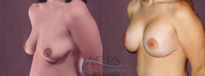 Before & After Breast Augmentation Case 835 Oblique Left View: View in Houston, TX