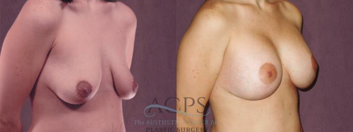 Before & After Breast Augmentation Case 835 Oblique Right View: View in Houston, TX