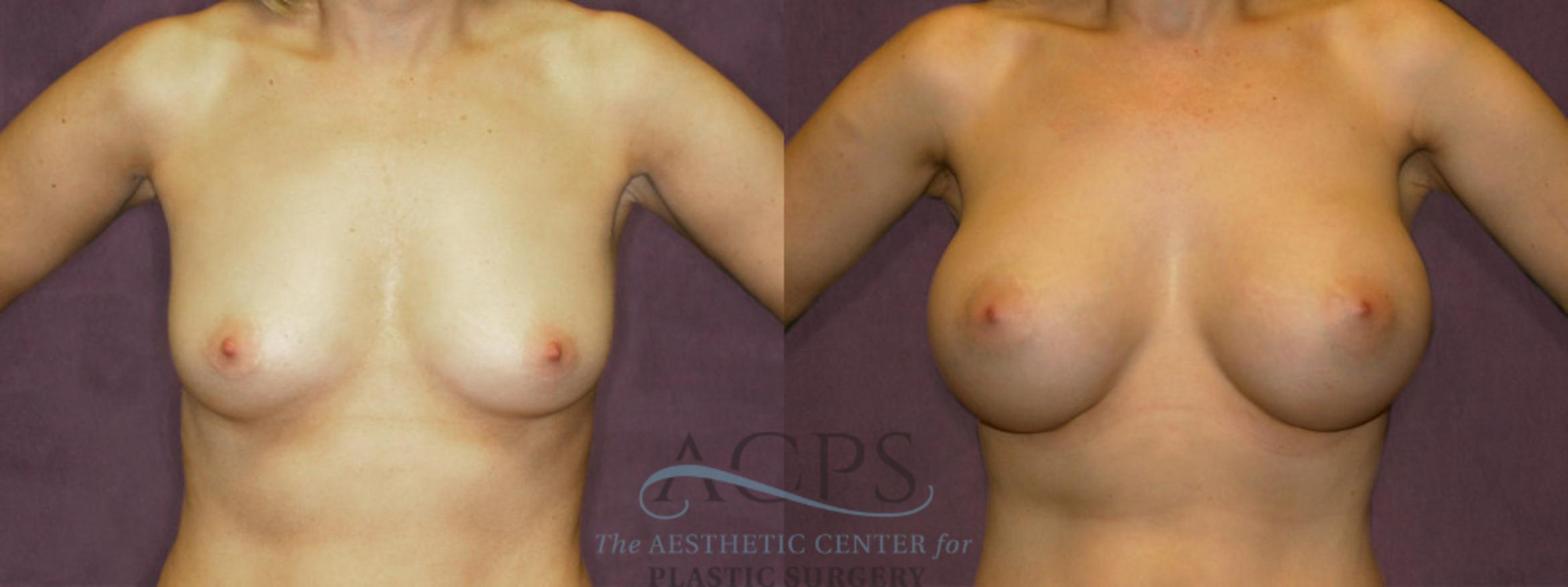Before & After Breast Augmentation Case 836 Front View: View in Houston, TX