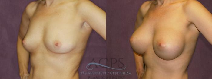Before & After Breast Augmentation Case 836 Oblique Left View: View in Houston, TX