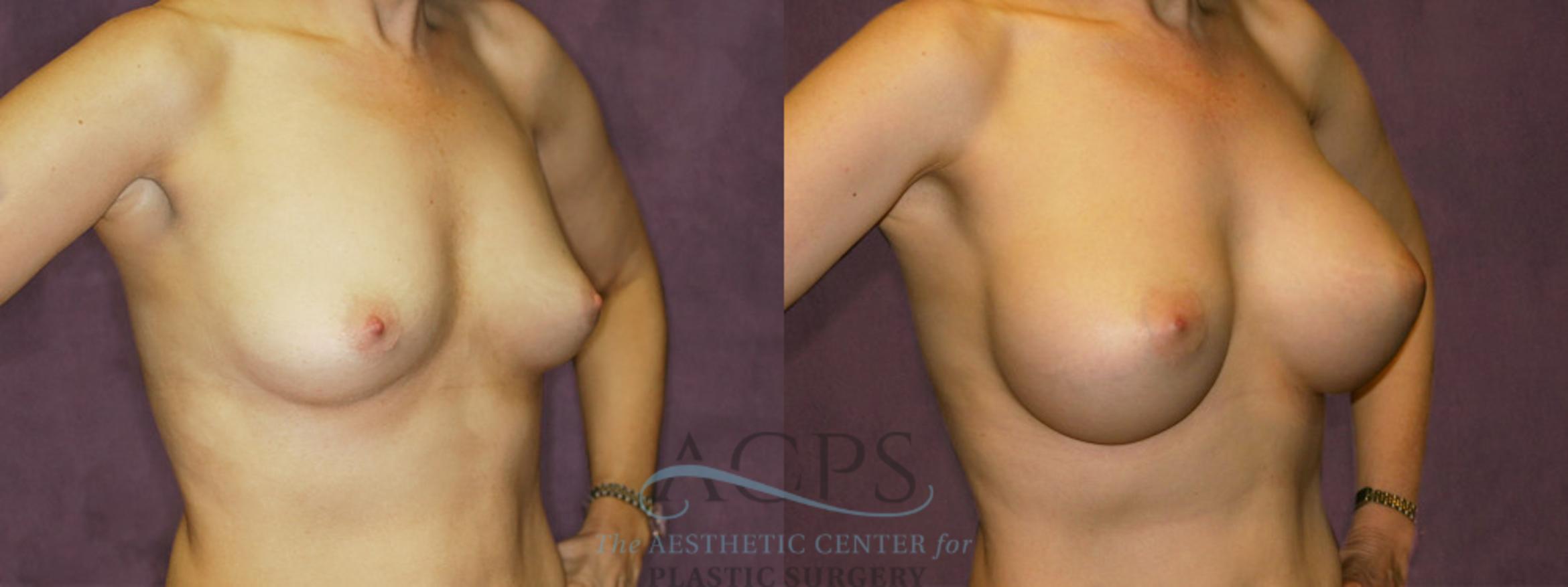 Before & After Breast Augmentation Case 836 Oblique Right View: View in Houston, TX