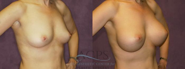Before & After Breast Augmentation Case 836 Oblique Right View: View in Houston, TX